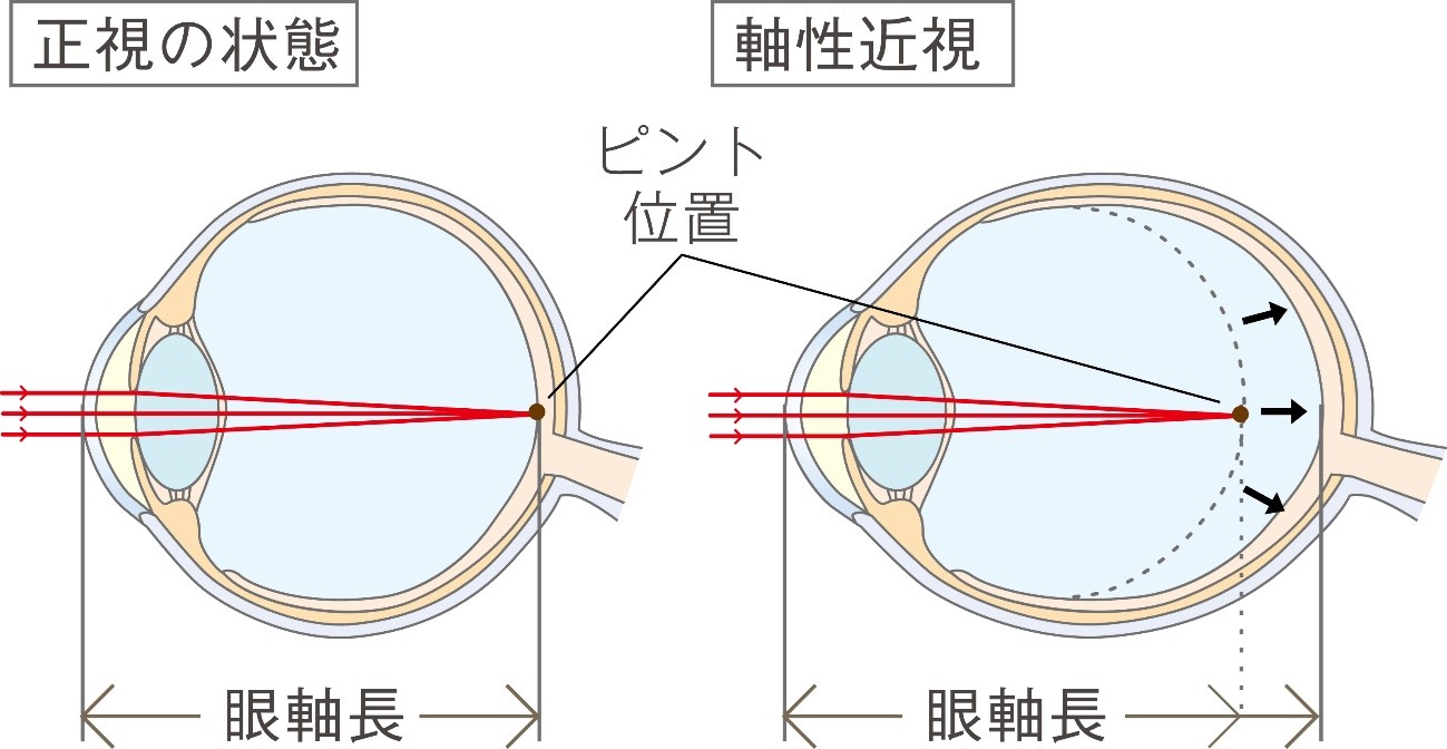 眼軸長